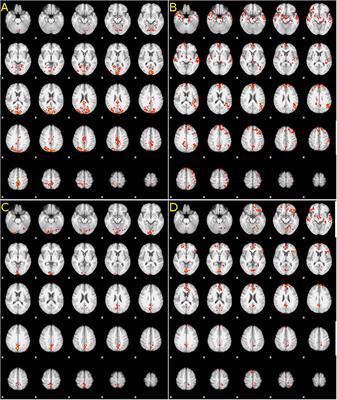 Modulation of Motor Cortex Activity After Intrathecal Baclofen Delivery in Chronic Thoracic Spinal Cord Injury